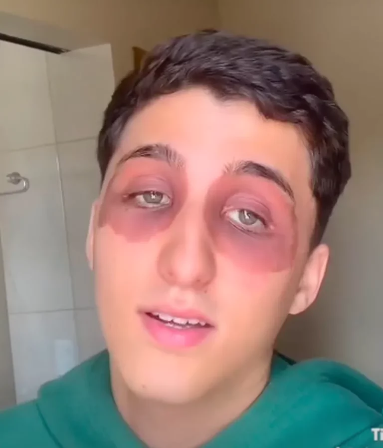 Jovem acordou com olhos inchados — Foto: Reprodução/TikTok