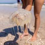 Como tratar uma queimadura de água-viva em crianças?